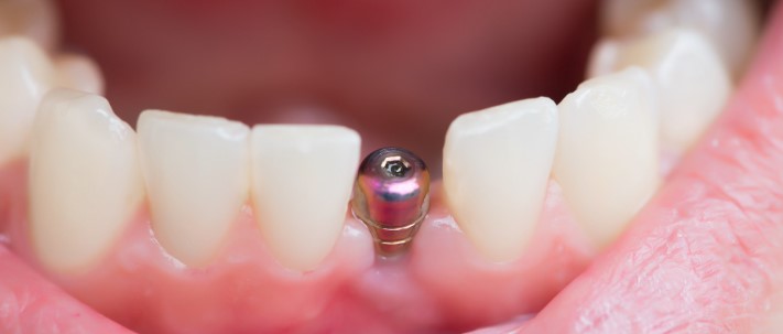 Discovering the Transformative Power of Dental Implants